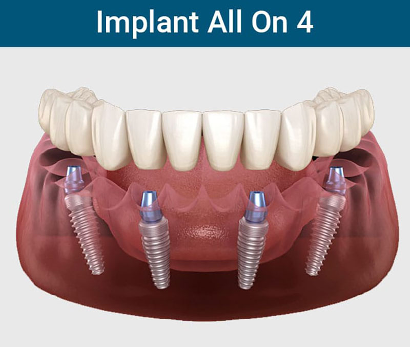 Cấy ghép implant toàn hàm