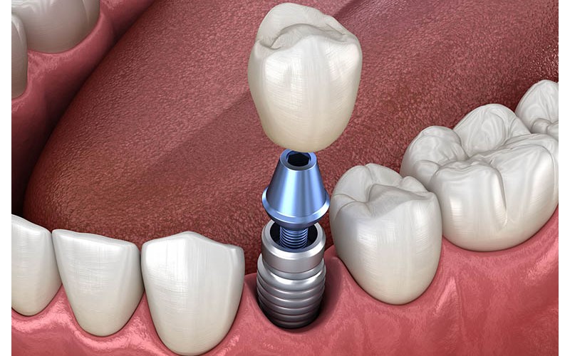 Cấy implant bao nhiêu tiền còn phụ thuộc vào tình trạng răng và dịch vụ lựa chọn