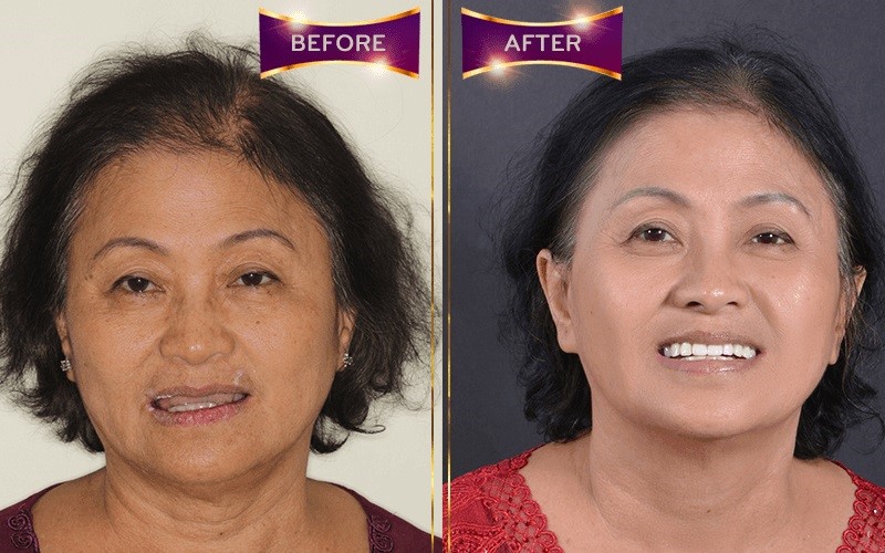 Hình ảnh khách hàng trước và sau khi trồng răng implant tại Worldwide