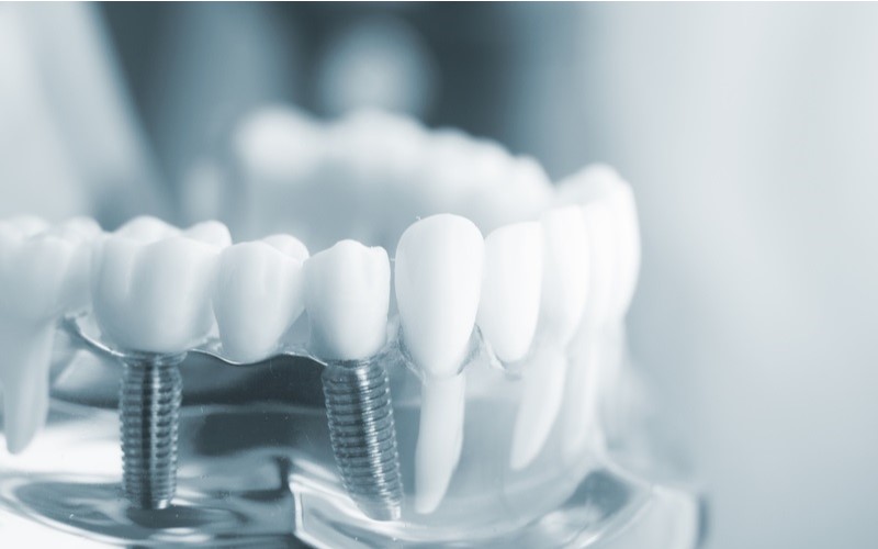 Khi làm răng implant cần lưu ý lựa chọn địa chỉ uy tín và chất lượng