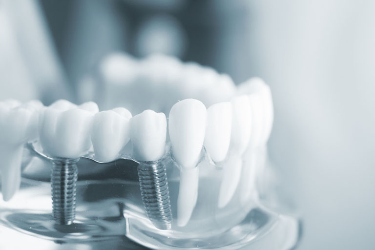 Làm răng implant ở đâu tốt TP. HCM?