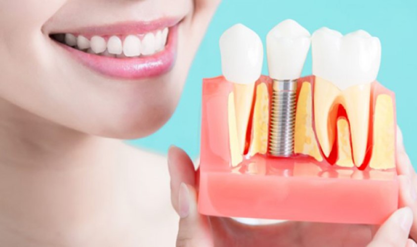 Trồng răng Implant giá bao nhiêu?