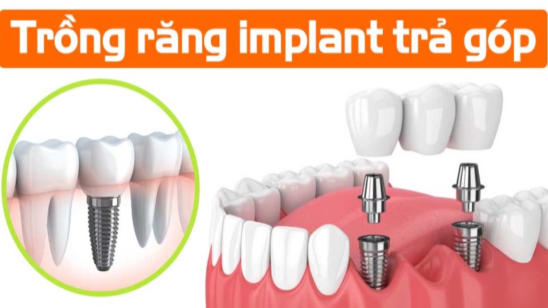 Trồng Răng Implant Trả Góp Tại Worldwide