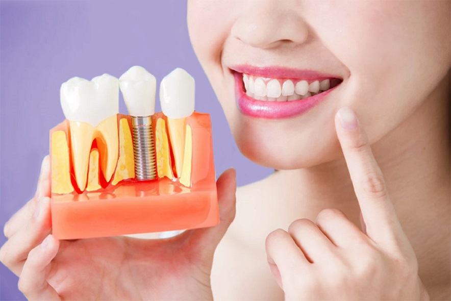 Giá cấy ghép răng implant phụ thuộc vào yếu tố nào?