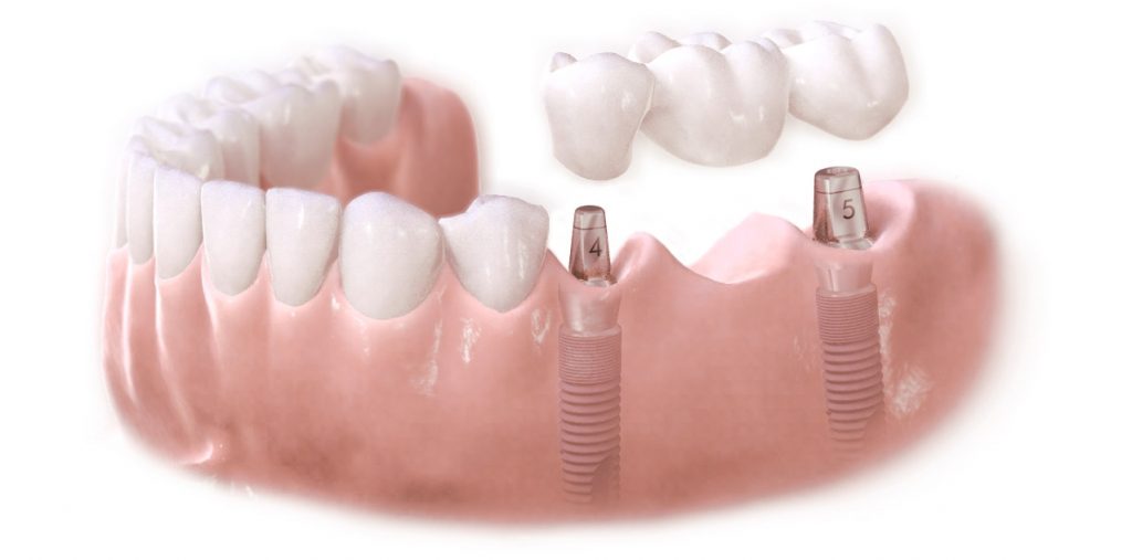 Kỹ thuật cấy ghép răng Implant cao cấp