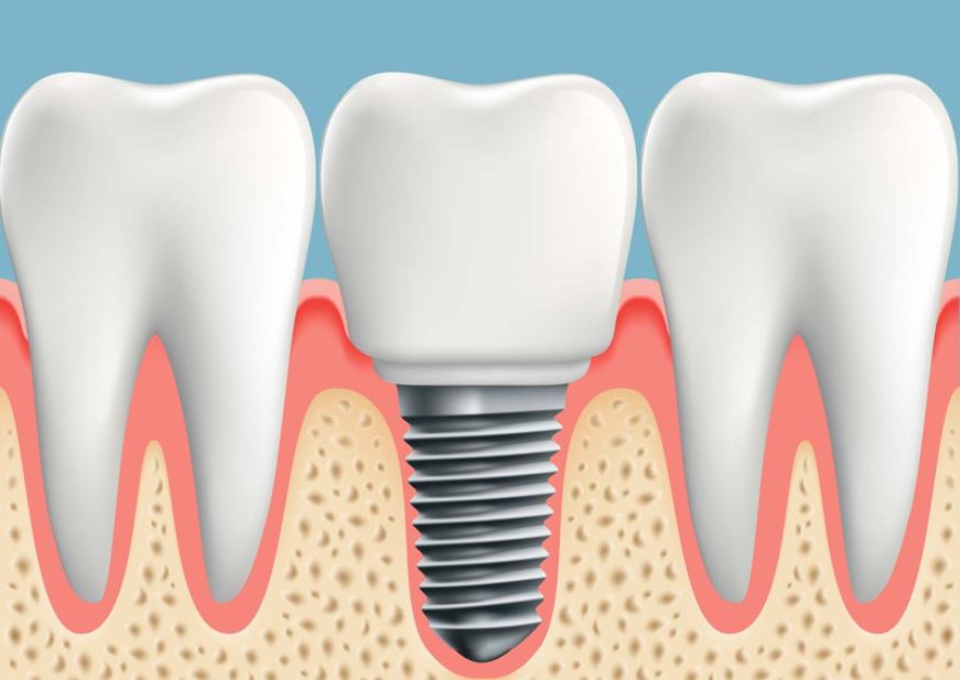 Phương pháp trồng răng implant có đau không?