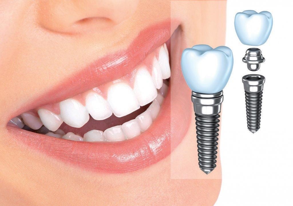Trồng răng bằng cấy ghép implant có thật sự tốt?