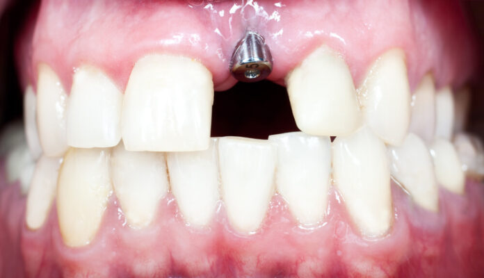 Trồng răng Implant tại HCM
