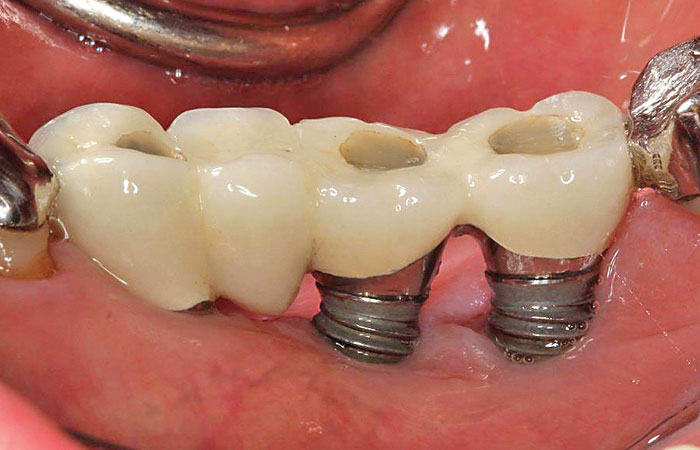 trong rang implant gia re tphcm