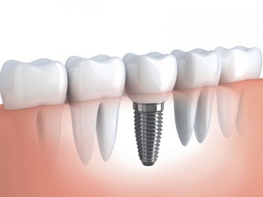 Nên làm răng implant ở đâu tốt TP. HCM?