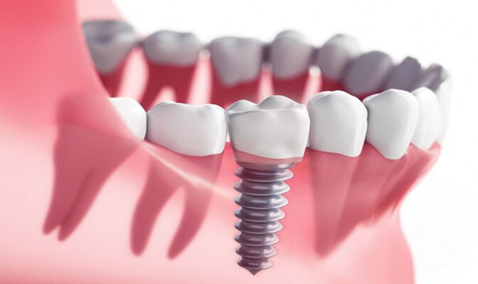 Răng sứ implant giá bao nhiêu?